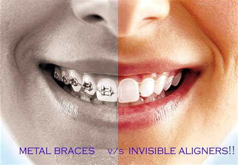 clear aligners vs braces